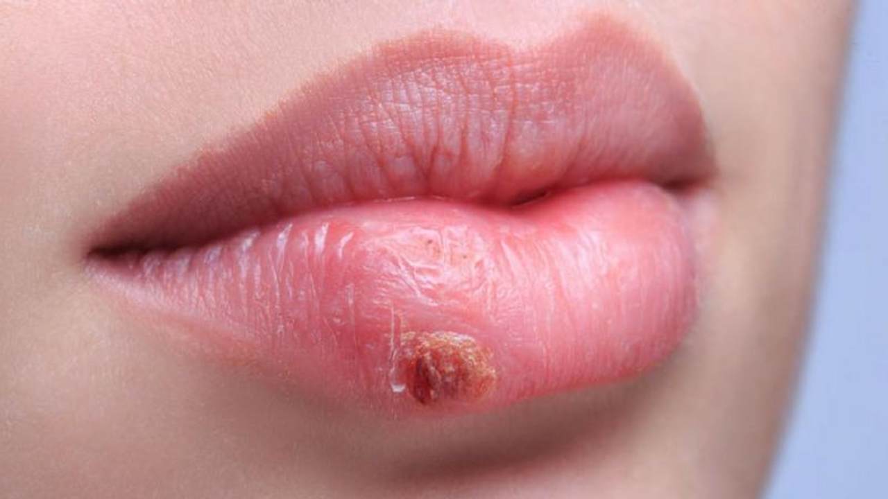 Herpes (foto web)