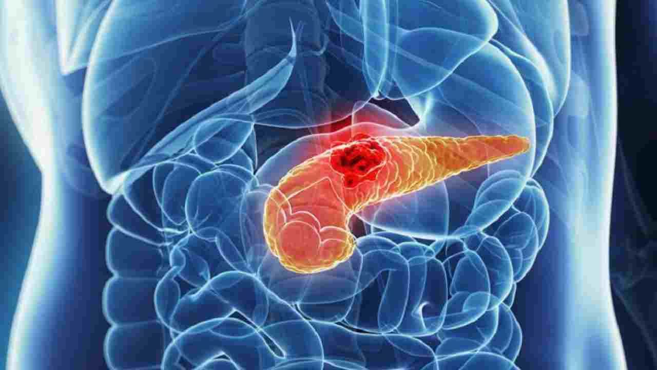 Tumore al pancreas (web source) 6.11.2022 crmag