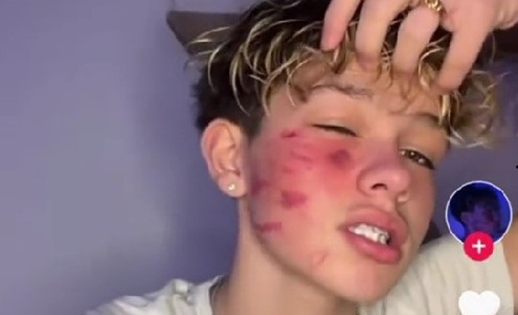 Challenge della cicatrice francese su TikTok: i rischi permanenti 